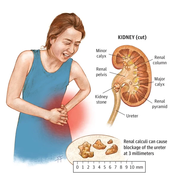 kidney stones