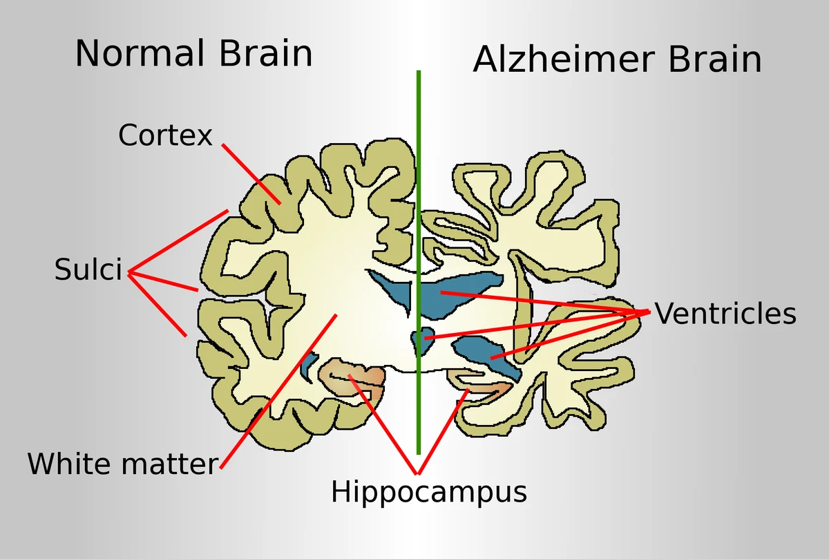 what is alzheimer disease