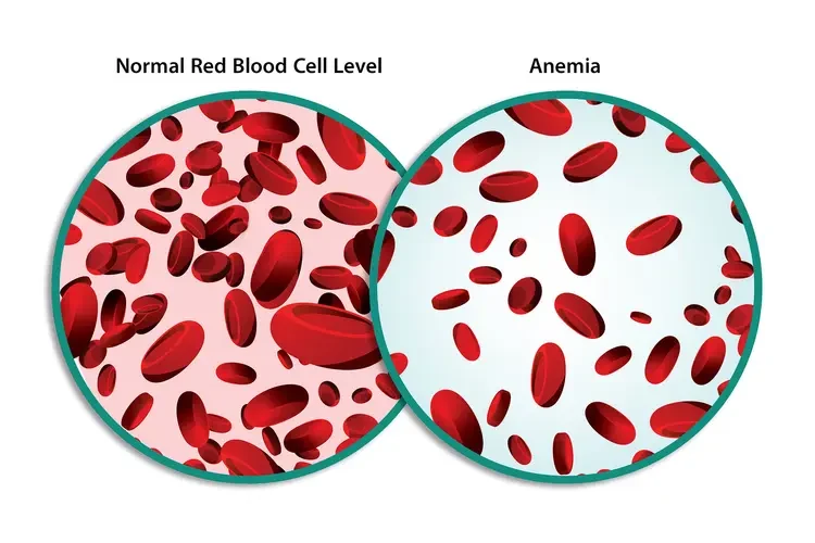 Anemia: Causes and Symptoms
