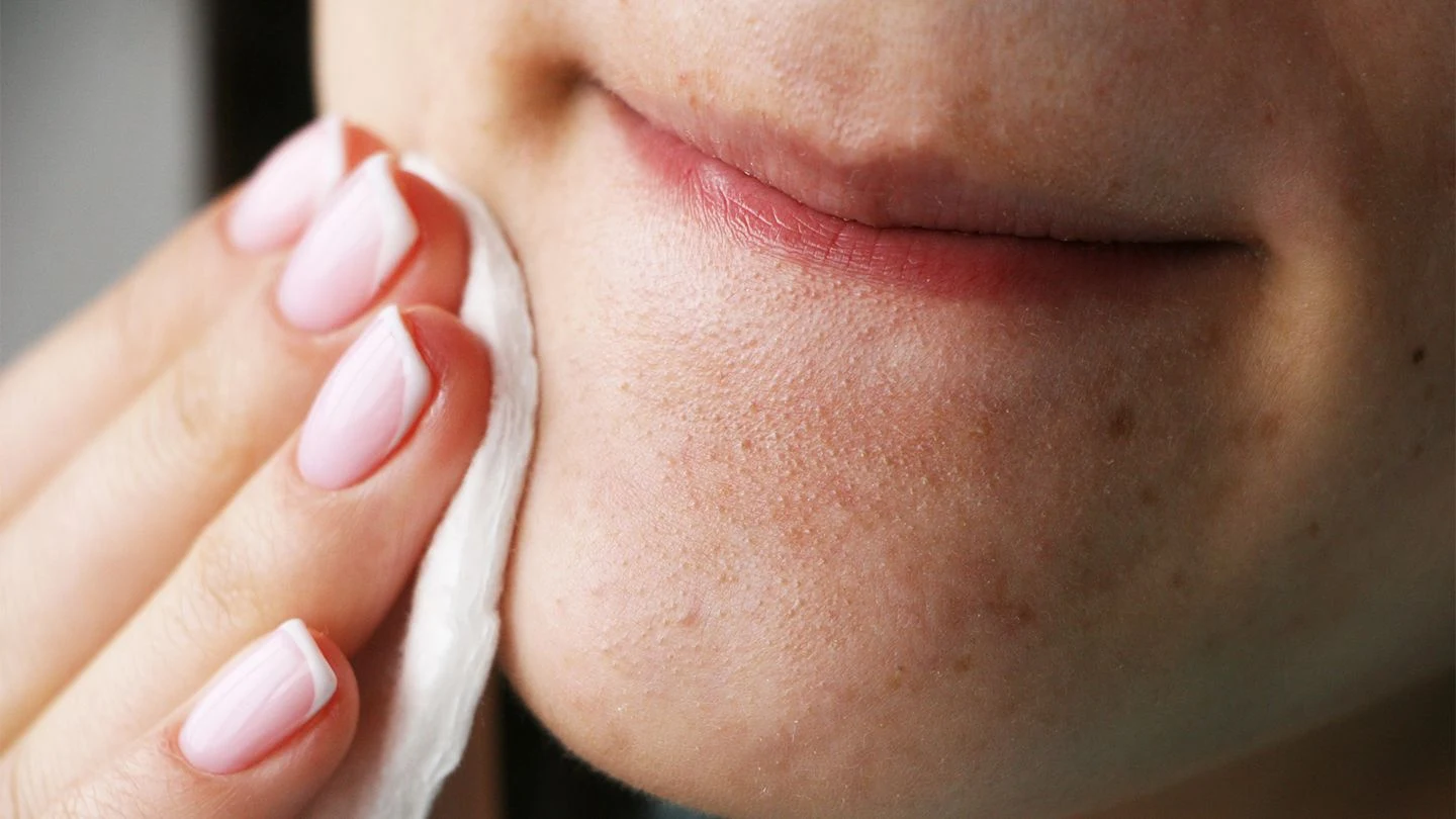 blackheads