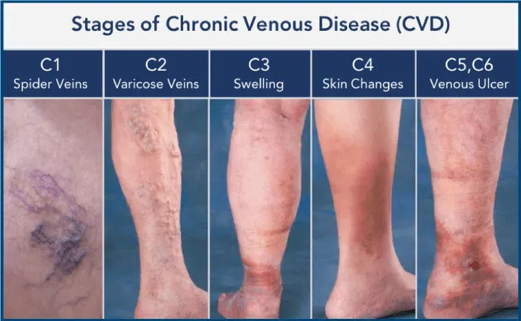cvc