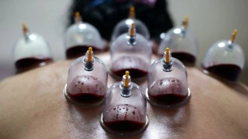 Cupping Therapy