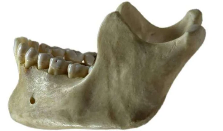 3,512 / 5,000 Translation results Lower jaw bone fracture