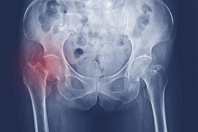 Fracture of the hip bone
