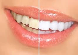 whiten teeth