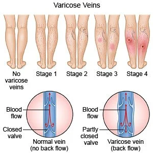 Diagram showing types of varicose veins