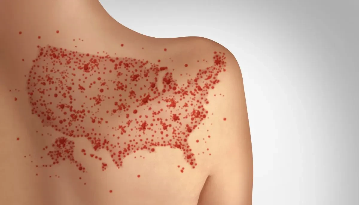 Measles Disease