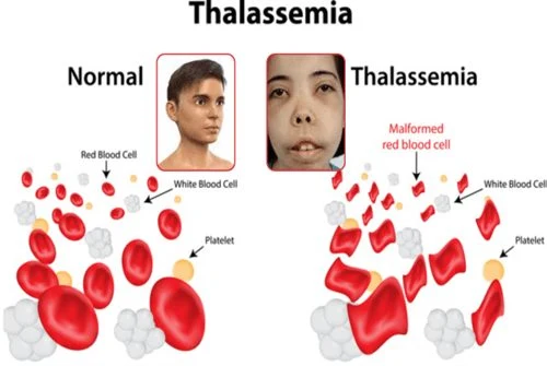 A Common Genetic Blood Disorder: Thalassemia