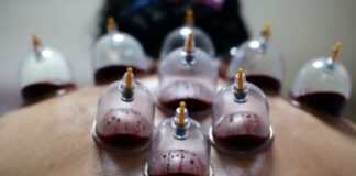 Cupping Magical Health Benefits Cupping Therapy