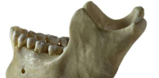 First aid, ParT (I) 3,512 / 5,000 Translation results Lower jaw bone fracture