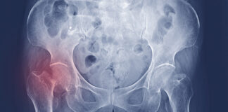 Fracture of the hip bone. Fracture of the hip bone