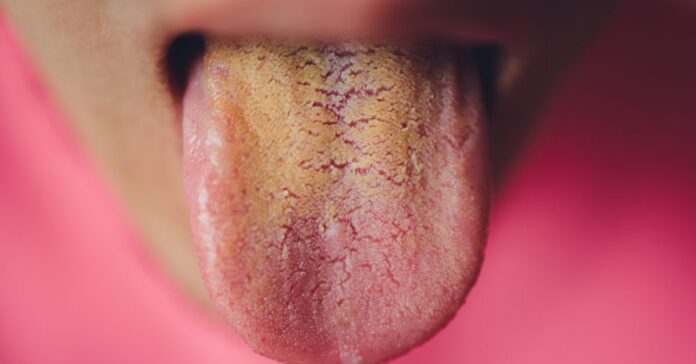 Yellow tongue indicates What disease