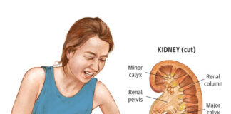 5 major symptoms of kidney stones and how to treat them kidney stones