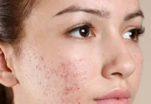 How to get rid of Acne? pimples
