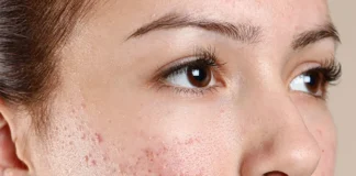 How to get rid of Acne? pimples