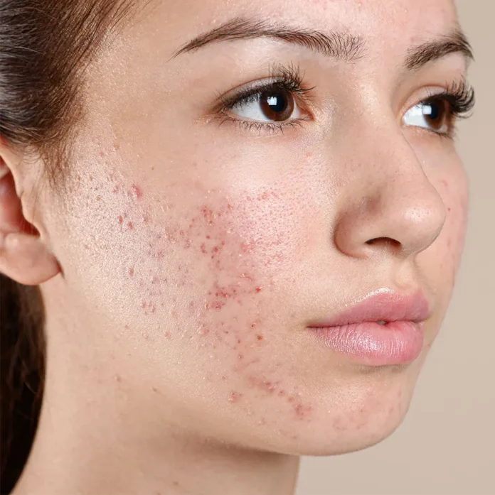 acne-treatments pimples