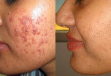 How To Get Rid Of Pimples acne