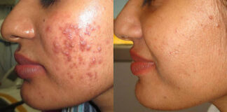 How To Get Rid Of Pimples acne