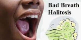 Halitosis bad breath halitosis