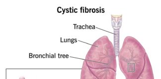 Cystic Fibrosis fibrosis