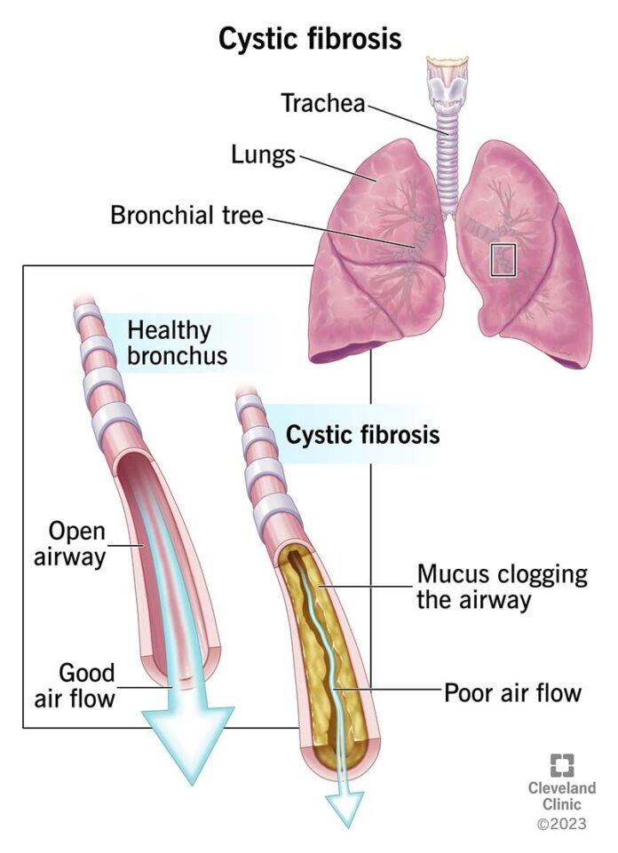 fibrosis