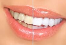 How To Whiten Teeth? whiten teeth