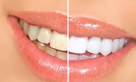 How To Whiten Teeth? whiten teeth