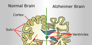 Alzheimer’s Disease what is alzheimer disease