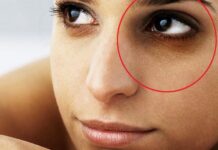 Remove Dark Circles!!! dark