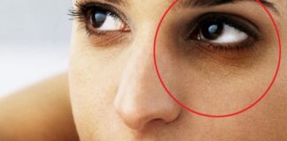 Remove Dark Circles!!! dark