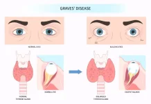 Graves’ Disease: Causes, Symptoms, and Treatment Graves' Disease: Causes, Symptoms, and Treatment